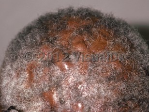 Clinical image of Dissecting cellulitis of scalp - imageId=60416. Click to open in gallery.  caption: 'Confluent shiny nodules with associated scarring alopecia on the scalp.'