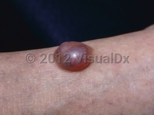 Clinical image of Nodular hidradenoma - imageId=6051125. Click to open in gallery.  caption: 'A close-up of a reddish-blue translucent nodule with overlying telangiectasias.'