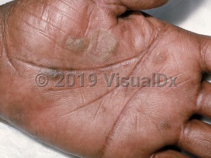 Clinical image of Epidermolysis bullosa simplex - imageId=605236. Click to open in gallery.  caption: 'Scaling and flaccid bullae on the palm.'
