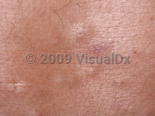 Clinical image of Eruptive vellus hair cyst - imageId=60528. Click to open in gallery.  caption: 'A close-up of several skincolored papules with tiny central puncta.'