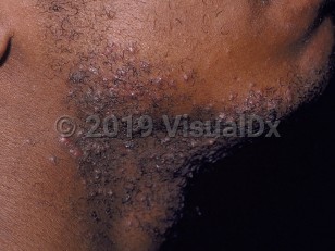 Clinical image of Pseudofolliculitis barbae - imageId=60574. Click to open in gallery.  caption: 'Perifollicular papules and pustules in the beard area.'