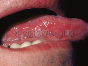 Clinical image of Oral hairy leukoplakia - imageId=60957. Click to open in gallery.  caption: 'White papules on lateral and ventral tongue.'