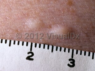 Clinical image of Multiple endocrine neoplasia type 1 - imageId=6105791. Click to open in gallery.  caption: 'A close-up of two yellowish-white papules (collagenomas).'