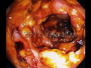 Imaging Studies image of Clostridioides difficile colitis - imageId=6107140. Click to open in gallery. 