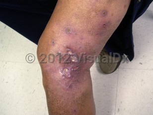 Clinical image of Mycobacterium fortuitum infection - imageId=6109596. Click to open in gallery.  caption: 'Violaceous plaques with central crusting and scarring on the leg, secondary to <i>M fortuitum</i>.'