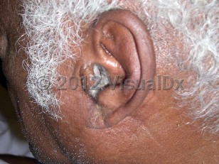 Clinical image of Malignant otitis externa