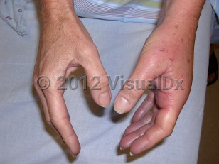 Clinical image of Animal bite infection - imageId=6112227. Click to open in gallery.  caption: '<span>Pasteurella multocida infection;</span> 24 hours post cat bite.<br />'