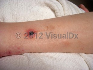 Clinical image of Paecilomyces lilacinus infection