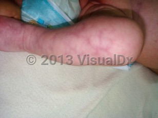 Clinical image of Adams-Oliver syndrome