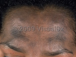 Clinical image of Ashy dermatosis - imageId=613263. Click to open in gallery.  caption: 'Violaceous and dark gray macules and patches on the forehead.'