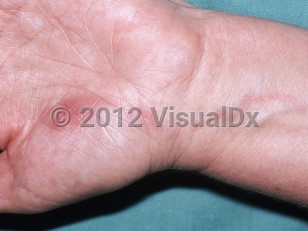Clinical image of Lymphangitis - imageId=6150795. Click to open in gallery.  caption: 'Subtle deeply erythematous papules and surrounding erythema on the palm (HSV) and a curvilinear erythematous streak extending proximally from it (lymphangitis).'