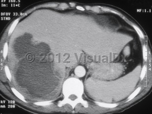 Imaging Studies image of Amebic liver abscess - imageId=6160904. Click to open in gallery. 