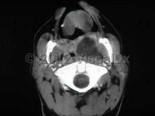 Imaging Studies image of Peritonsillar abscess - imageId=6161291. Click to open in gallery. 