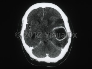 Imaging Studies image of Brain abscess - imageId=6161408. Click to open in gallery. 