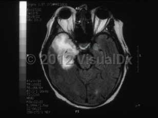 Imaging Studies image of Herpes simplex virus encephalitis - imageId=6173583. Click to open in gallery. 