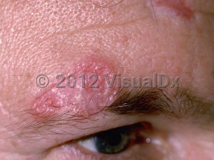 Clinical image of Discoid lupus erythematosus - imageId=61744. Click to open in gallery.  caption: 'An atrophic, scarred, pink plaque with raised borders on the lower forehead and eyebrow. Note the permanent loss of eyebrow hairs within the scarred area.'