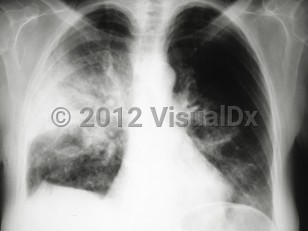 Imaging Studies image of Acute eosinophilic pneumonia