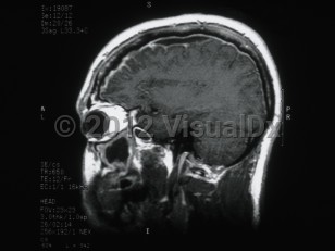 Imaging Studies image of Subdural empyema