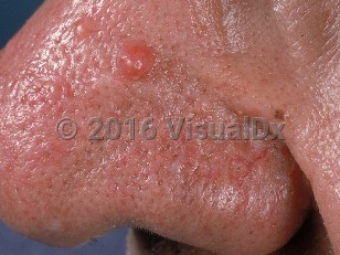 Clinical image of Fibrous papule of nose - imageId=620742. Click to open in gallery.  caption: 'A small, smooth, well-demarcated, reddish papule on the nose. Note other similar skin-colored papules in the vicinity (more fibrous papules).'