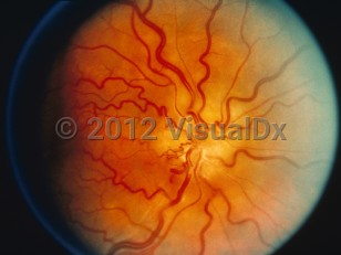 Clinical image of Papilledema - imageId=6207488. Click to open in gallery. 