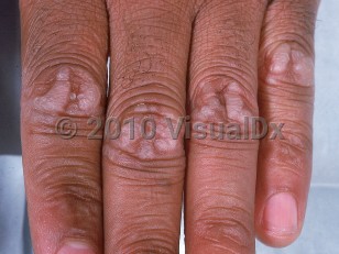 Clinical image of Focal acral hyperkeratosis