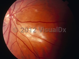 Clinical image of Cytomegalovirus retinitis