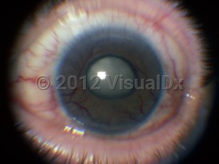 Clinical image of Neovascular glaucoma