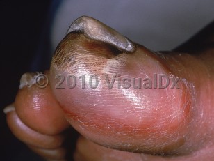 Clinical image of Frostbite - imageId=623105. Click to open in gallery.  caption: 'A necrotic, violaceous, crusted plaque with an erythematous rim on the toe.'
