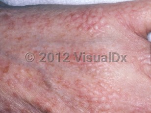 Clinical image of Papular mucinosis - imageId=6239552. Click to open in gallery.  caption: 'Numerous smooth, whitish papules coalescing to form plaques, with surrounding erythema, on the dorsal hand.'