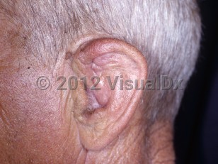 Clinical image of Chronic hematoma of pinna - imageId=6243584. Click to open in gallery.  caption: 'A deformed auricle.'