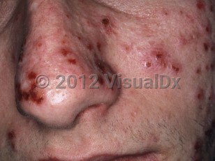 Clinical image of Hydroa vacciniforme - imageId=6244963. Click to open in gallery.  caption: 'Multiple crusts and a few faint pink papules on the central face.'