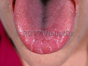 Clinical image of Migratory glossitis - imageId=628517. Click to open in gallery.  caption: 'Red, depapillated plaques with surrounding serpiginous, raised white borders on the distal tongue.'