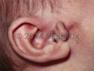 Clinical image of Goldenhar syndrome - imageId=6314460. Click to open in gallery. 