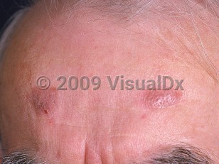 Clinical image of Granuloma faciale - imageId=631808. Click to open in gallery.  caption: 'A pink plaque with a peau d'orange appearance and another plaque with a pinkish-brown hue on the forehead.'