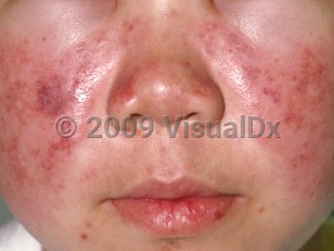 Clinical image of Systemic lupus erythematosus
