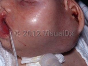 Clinical image of Malignant teratoma - imageId=6352483. Click to open in gallery.  caption: 'A large subcutaneous mass on the lateral cheek distorting the face and ear. Note also the hemorrhagic ear discharge.'