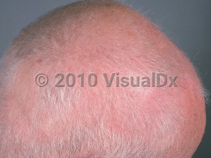 Clinical image of Graham-Little syndrome - imageId=636952. Click to open in gallery.  caption: 'Patchy scarring alopecia on the scalp.'