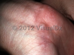 Clinical image of Neurilemmoma - imageId=6373728. Click to open in gallery.  caption: 'A smooth whitish papule at the wrist.'