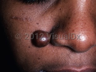 Clinical image of Chondroid syringoma - imageId=6378337. Click to open in gallery.  caption: 'A smooth, deep brown nodule on the medial cheek.'