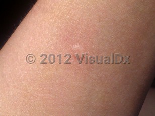 Clinical image of Wasp or yellow jacket sting - imageId=6380700. Click to open in gallery.  caption: 'An edematous papule with a central tiny punctum and a surrounding red flare on the arm.'