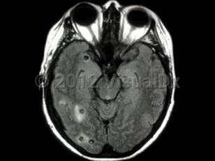 Imaging Studies image of Neurocysticercosis - imageId=6397887. Click to open in gallery. 