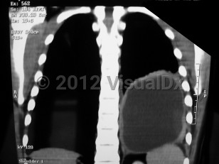 Imaging Studies image of Echinococcosis