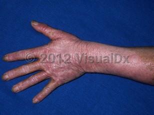 Clinical image of Chronic actinic dermatitis - imageId=6412490. Click to open in gallery.  caption: 'Diffuse, pink, scaly and lichenified plaques on the photoexposed forearm, dorsal hand, and fingers.'