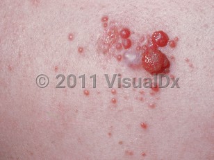 Clinical image of Hemangiopericytoma - imageId=642368. Click to open in gallery.  caption: 'A close-up of a cluster of smooth and glistening red papules of varying sizes.'