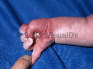 Clinical image of Sturge-Weber syndrome - imageId=6428124. Click to open in gallery.  caption: 'An extensive mottled, red patch on the arm and hand.'