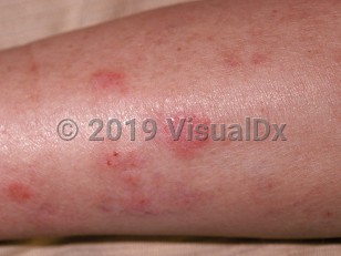 Clinical image of Cytomegalovirus infection - imageId=64333. Click to open in gallery.  caption: 'Erythematous, edematous papules and plaques on the leg with scattered overlying crusts.'