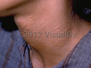 Clinical image of Pseudoxanthoma elasticum - imageId=64511. Click to open in gallery.  caption: 'Yellowish papules and plaques, some with central umbilication, on the neck.'