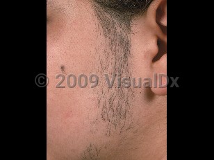 Clinical image of Hirsutism