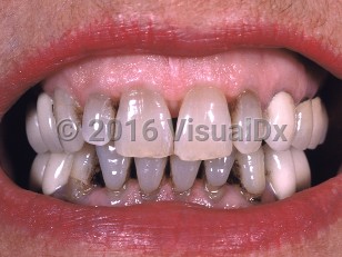 Clinical image of Drug-induced oral pigmentation - imageId=650652. Click to open in gallery.  caption: 'A blue-gray discoloration of teeth.'