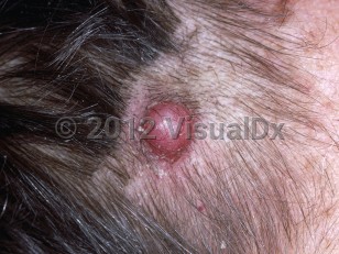 Clinical image of Cutaneous leiomyosarcoma - imageId=6511732. Click to open in gallery.  caption: 'A smooth dull pink nodule with overlying telangiectasias on the scalp.'